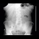 Metallic coils in abdomen: X-ray - Plain radiograph